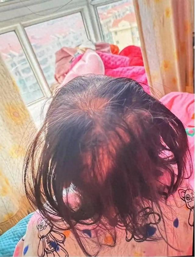 湖南3岁女童突然脱发查出铊中毒，她究竟是怎么中毒的呢？
