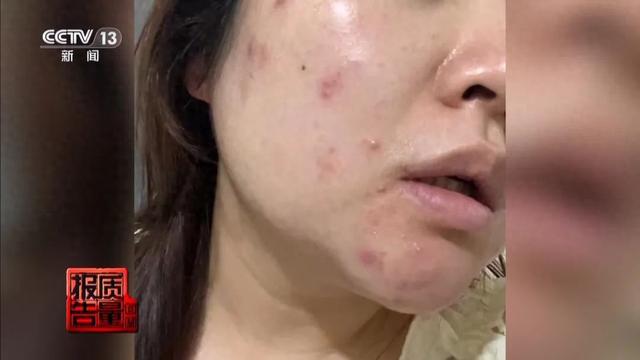 女子美容院祛痘，竟越祛越多！医生紧急提醒→
