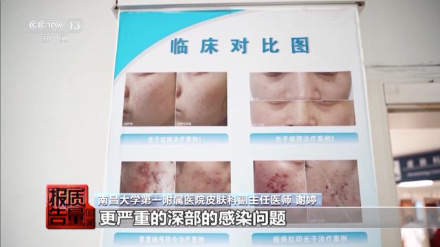 女子美容院祛痘，竟越祛越多！医生紧急提醒→